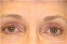 Eyelid Surgery After Photo by Ricardo Rodriguez, MD; Lutherville-Timonium, MD - Case 32548