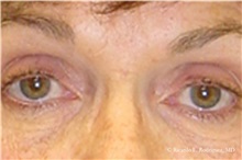 Eyelid Surgery Before Photo by Ricardo Rodriguez, MD; Lutherville-Timonium, MD - Case 32548