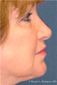 Facelift After Photo by Ricardo Rodriguez, MD; Lutherville-Timonium, MD - Case 32549