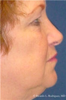 Facelift Before Photo by Ricardo Rodriguez, MD; Lutherville-Timonium, MD - Case 32549