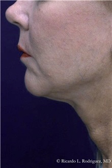 Facelift After Photo by Ricardo Rodriguez, MD; Lutherville-Timonium, MD - Case 32552