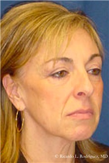 Facelift Before Photo by Ricardo Rodriguez, MD; Lutherville-Timonium, MD - Case 32553
