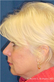 Facelift After Photo by Ricardo Rodriguez, MD; Lutherville-Timonium, MD - Case 32554