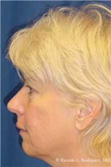 Facelift Before Photo by Ricardo Rodriguez, MD; Lutherville-Timonium, MD - Case 32554