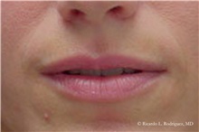 Lip Augmentation/Enhancement Before Photo by Ricardo Rodriguez, MD; Lutherville-Timonium, MD - Case 32557