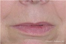 Lip Augmentation/Enhancement Before Photo by Ricardo Rodriguez, MD; Lutherville-Timonium, MD - Case 32558