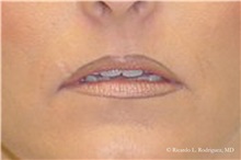 Lip Augmentation/Enhancement Before Photo by Ricardo Rodriguez, MD; Lutherville-Timonium, MD - Case 32559