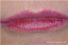 Lip Augmentation/Enhancement After Photo by Ricardo Rodriguez, MD; Lutherville-Timonium, MD - Case 32560