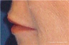 Lip Augmentation/Enhancement After Photo by Ricardo Rodriguez, MD; Lutherville-Timonium, MD - Case 32561