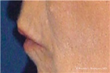 Lip Augmentation/Enhancement Before Photo by Ricardo Rodriguez, MD; Lutherville-Timonium, MD - Case 32561