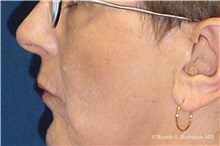 Lip Augmentation/Enhancement Before Photo by Ricardo Rodriguez, MD; Lutherville-Timonium, MD - Case 32562
