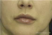 Lip Augmentation/Enhancement Before Photo by Ricardo Rodriguez, MD; Lutherville-Timonium, MD - Case 32563