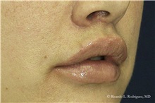 Lip Augmentation/Enhancement After Photo by Ricardo Rodriguez, MD; Lutherville-Timonium, MD - Case 32563