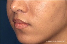 Lip Augmentation/Enhancement After Photo by Ricardo Rodriguez, MD; Lutherville-Timonium, MD - Case 32564