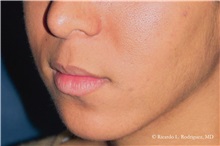Lip Augmentation/Enhancement Before Photo by Ricardo Rodriguez, MD; Lutherville-Timonium, MD - Case 32564