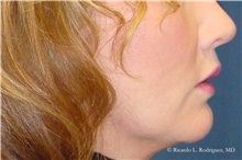 Lip Augmentation/Enhancement After Photo by Ricardo Rodriguez, MD; Lutherville-Timonium, MD - Case 32566