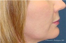 Lip Augmentation/Enhancement Before Photo by Ricardo Rodriguez, MD; Lutherville-Timonium, MD - Case 32566