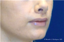 Lip Augmentation/Enhancement After Photo by Ricardo Rodriguez, MD; Lutherville-Timonium, MD - Case 32567