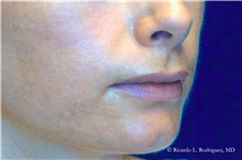 Lip Augmentation/Enhancement Before Photo by Ricardo Rodriguez, MD; Lutherville-Timonium, MD - Case 32567