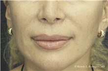 Lip Augmentation/Enhancement After Photo by Ricardo Rodriguez, MD; Lutherville-Timonium, MD - Case 32568