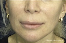 Lip Augmentation/Enhancement Before Photo by Ricardo Rodriguez, MD; Lutherville-Timonium, MD - Case 32568