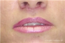 Lip Augmentation/Enhancement After Photo by Ricardo Rodriguez, MD; Lutherville-Timonium, MD - Case 32569