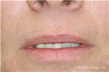 Lip Augmentation/Enhancement Before Photo by Ricardo Rodriguez, MD; Lutherville-Timonium, MD - Case 32569