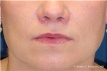 Lip Augmentation/Enhancement After Photo by Ricardo Rodriguez, MD; Lutherville-Timonium, MD - Case 32572