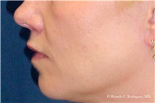 Lip Augmentation/Enhancement After Photo by Ricardo Rodriguez, MD; Lutherville-Timonium, MD - Case 32572