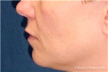 Lip Augmentation/Enhancement Before Photo by Ricardo Rodriguez, MD; Lutherville-Timonium, MD - Case 32572