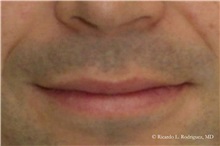 Lip Augmentation/Enhancement Before Photo by Ricardo Rodriguez, MD; Lutherville-Timonium, MD - Case 32574