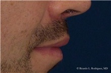 Lip Augmentation/Enhancement After Photo by Ricardo Rodriguez, MD; Lutherville-Timonium, MD - Case 32574