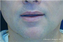 Lip Augmentation/Enhancement After Photo by Ricardo Rodriguez, MD; Lutherville-Timonium, MD - Case 32575