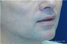 Lip Augmentation/Enhancement After Photo by Ricardo Rodriguez, MD; Lutherville-Timonium, MD - Case 32575