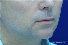 Lip Augmentation/Enhancement Before Photo by Ricardo Rodriguez, MD; Lutherville-Timonium, MD - Case 32575