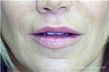 Lip Augmentation/Enhancement After Photo by Ricardo Rodriguez, MD; Lutherville-Timonium, MD - Case 32576