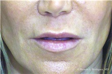Lip Augmentation/Enhancement Before Photo by Ricardo Rodriguez, MD; Lutherville-Timonium, MD - Case 32576