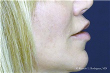 Lip Augmentation/Enhancement After Photo by Ricardo Rodriguez, MD; Lutherville-Timonium, MD - Case 32576