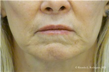 Lip Augmentation/Enhancement After Photo by Ricardo Rodriguez, MD; Lutherville-Timonium, MD - Case 32577