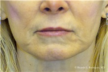 Lip Augmentation/Enhancement Before Photo by Ricardo Rodriguez, MD; Lutherville-Timonium, MD - Case 32577