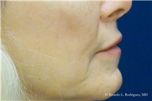 Lip Augmentation/Enhancement After Photo by Ricardo Rodriguez, MD; Lutherville-Timonium, MD - Case 32577