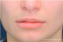 Lip Augmentation/Enhancement After Photo by Ricardo Rodriguez, MD; Lutherville-Timonium, MD - Case 32578