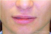 Lip Augmentation/Enhancement Before Photo by Ricardo Rodriguez, MD; Lutherville-Timonium, MD - Case 32578