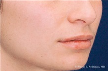 Lip Augmentation/Enhancement After Photo by Ricardo Rodriguez, MD; Lutherville-Timonium, MD - Case 32578