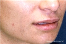 Lip Augmentation/Enhancement Before Photo by Ricardo Rodriguez, MD; Lutherville-Timonium, MD - Case 32578