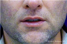 Lip Augmentation/Enhancement After Photo by Ricardo Rodriguez, MD; Lutherville-Timonium, MD - Case 32579