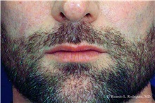 Lip Augmentation/Enhancement Before Photo by Ricardo Rodriguez, MD; Lutherville-Timonium, MD - Case 32579