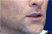 Lip Augmentation/Enhancement After Photo by Ricardo Rodriguez, MD; Lutherville-Timonium, MD - Case 32579