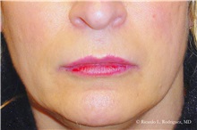 Lip Augmentation/Enhancement After Photo by Ricardo Rodriguez, MD; Lutherville-Timonium, MD - Case 32580