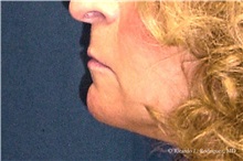 Lip Augmentation/Enhancement Before Photo by Ricardo Rodriguez, MD; Lutherville-Timonium, MD - Case 32580